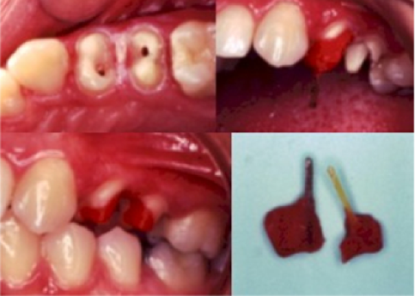 Poste dental colado paralelo