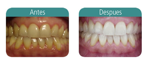 Antes y despues dela Ortodoncia