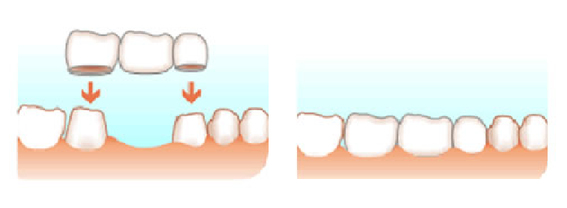 Ejemplo de Puente Dental