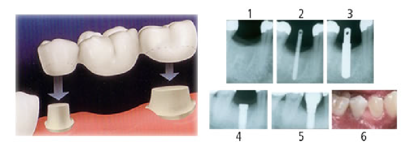 Implantes Dentales